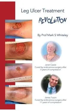 Leg Ulcer Treatment Revolution - Mark S. Whiteley