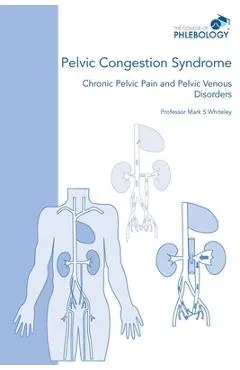 Pelvic Congestion Syndrome - Chronic Pelvic Pain and Pelvic Venous Disorders - Mark S. Whiteley